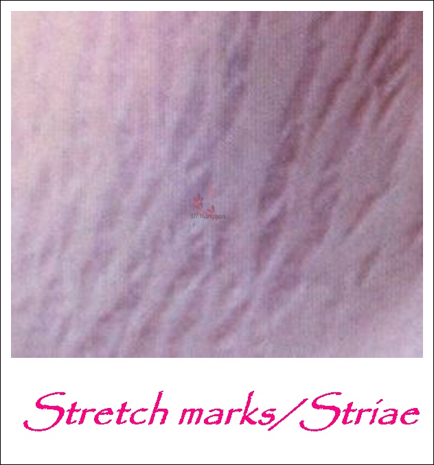 Sanhi ng stretch marks o striae
